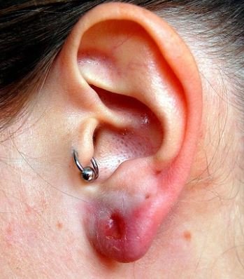 Ear Piercing Treatment in Pune
