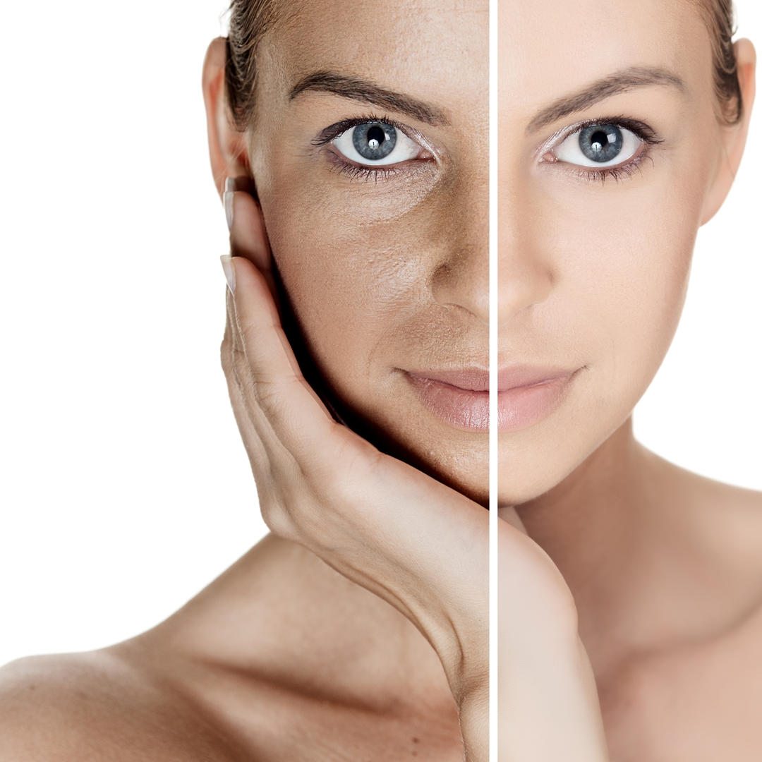 Skin Rejuvenation Treatment in Pimpri Chinchwad Pune