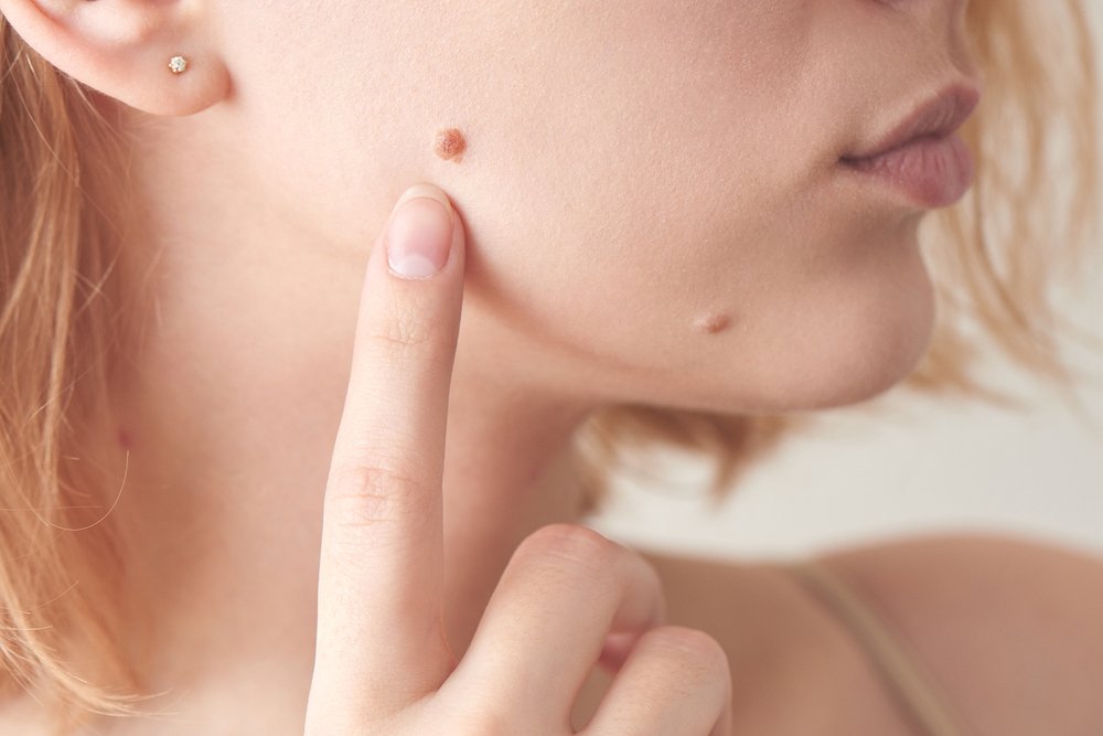Mole Removal Treatment in Pimpri Chinchwad