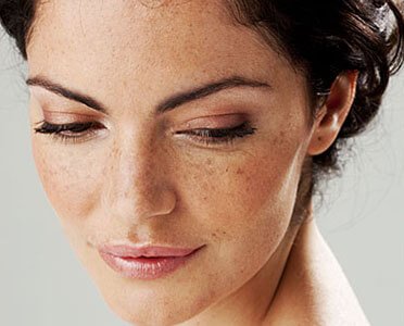 Melasma Treatment in Pune