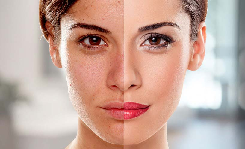 Skin Lightening Treatment In Pimpri Chinchwad Pune