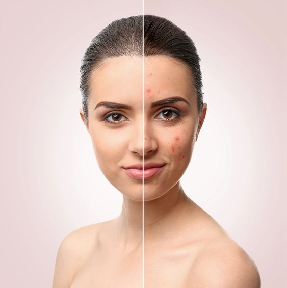 Age Spots Treatment In Pune