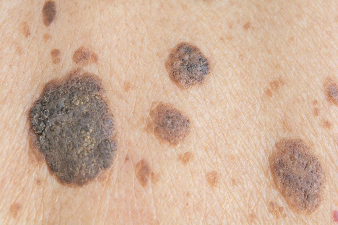 Seborrheic Keratosis Treatment In Pune