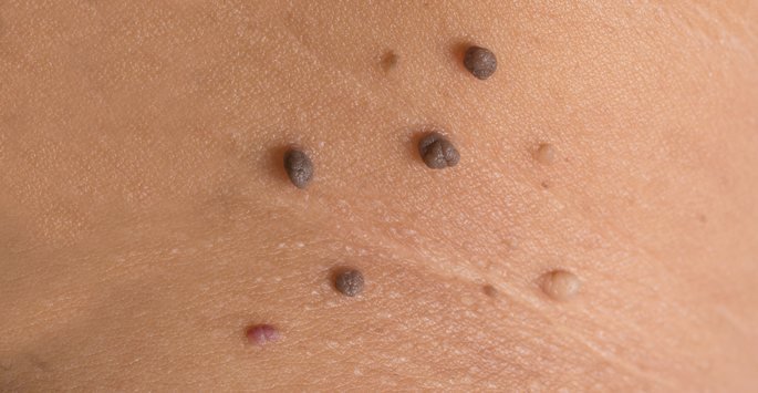 Skin Tag Removal Treatment in Pimpri Chinchwad