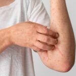 Skin Allergy Vs. Fungal Infection