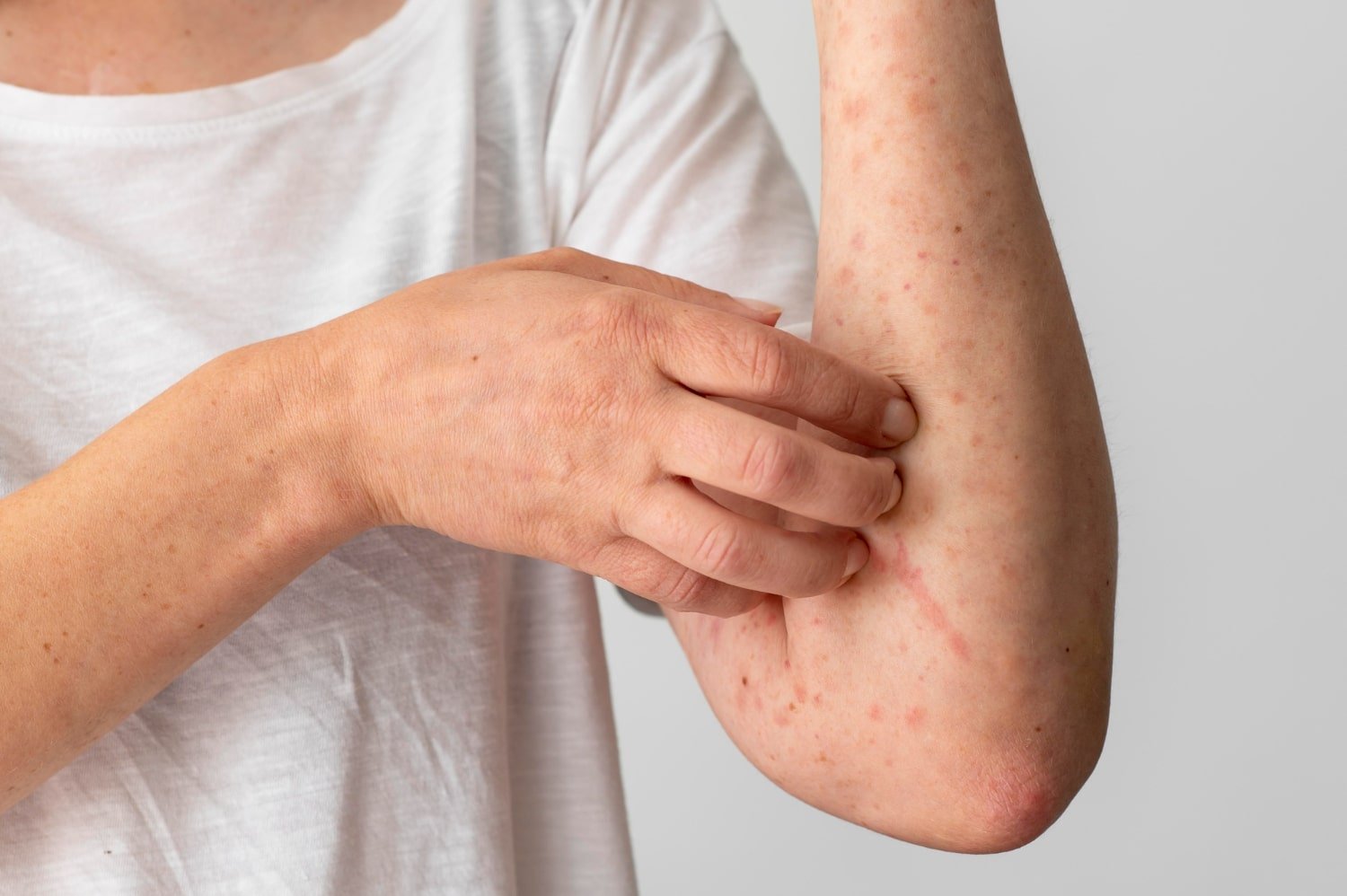 Skin Allergy Vs. Fungal Infection: Know The Difference