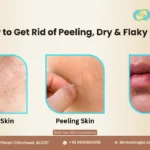 How to Get Rid of Peeling, Dry & Flaky Skin